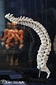 VBS_3052 - Degenerazione della colonna vertebrale. Spondilosi - Mostra Body Worlds